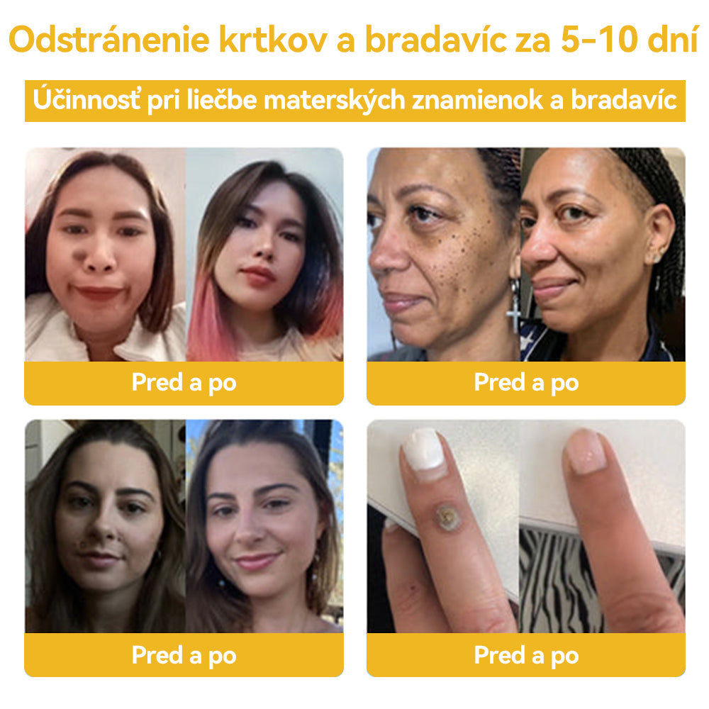 🍓𝑺𝒑𝒛𝒗™ 𝑽č𝒆𝒍í 𝒋𝒆𝒅 𝑲𝒓é𝒎 𝒏𝒂 𝒐š𝒆𝒕𝒓𝒆𝒏𝒊𝒆 𝒌𝒓𝒕𝒌𝒐𝒗 𝒂 𝒃𝒓𝒂𝒅𝒂𝒗í𝒄⚡⚡(🧑⚕️𝑶𝒅𝒑𝒐𝒓úč𝒂𝒏𝒊𝒆 š𝒑𝒆𝒄𝒊𝒂𝒍𝒊𝒔𝒕𝒖 𝒅𝒆𝒓𝒎𝒂𝒕𝒐𝒍ó𝒈𝒂🔥🔥𝑷𝒐𝒔𝒍𝒆𝒅𝒏ý 𝒅𝒆ň 𝒑𝒓𝒐𝒑𝒂𝒈á𝒄𝒊𝒆 80% 𝒗𝒚𝒑𝒏𝒖𝒕é)